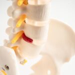 Lumbar spine displaced herniated disc fragment, spinal nerve and bone.