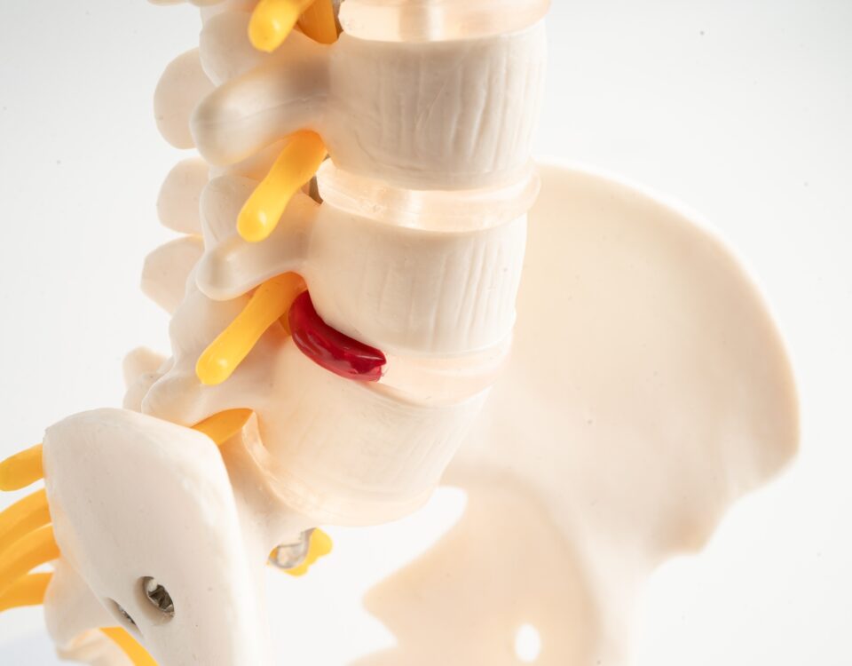 Lumbar spine displaced herniated disc fragment, spinal nerve and bone.