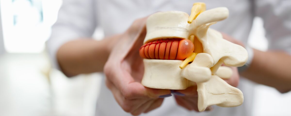 The doctor holds in his hands a model of a herniated lumbar disc of the spine
