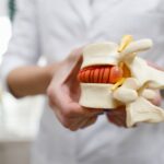 The doctor holds in his hands a model of a herniated lumbar disc of the spine