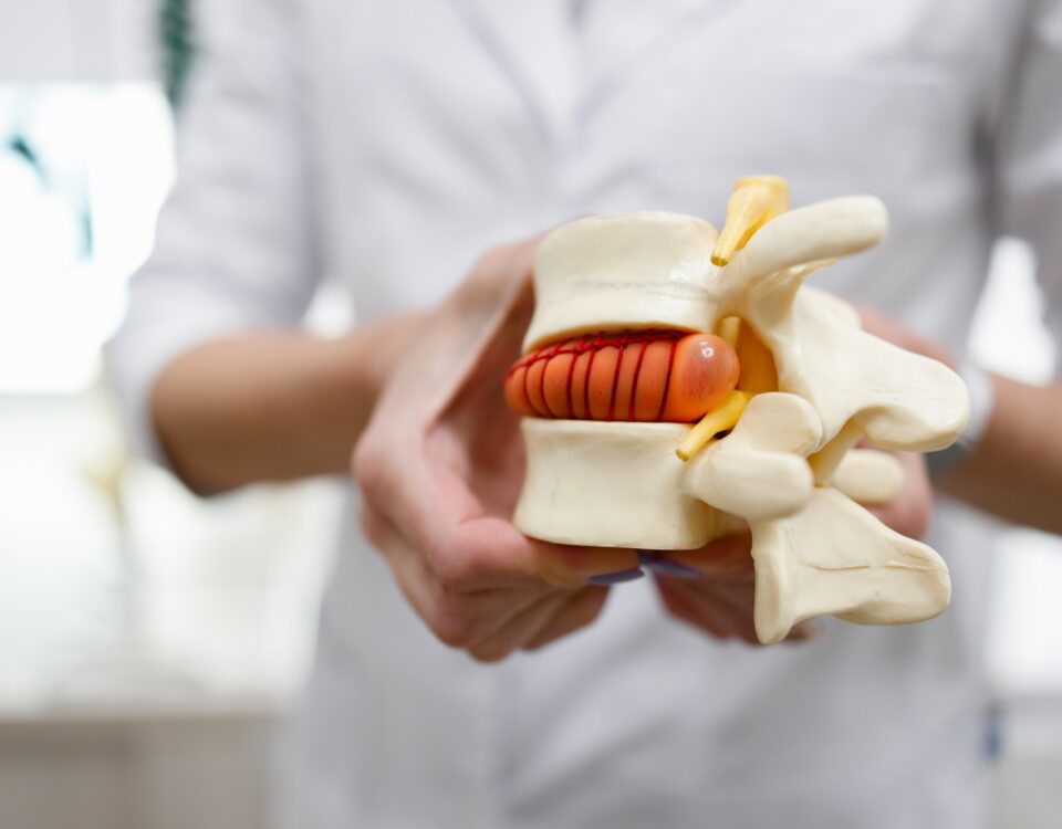 The doctor holds in his hands a model of a herniated lumbar disc of the spine